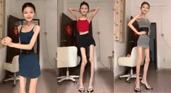 Viral Wanita Kurus Asal China Ini Hanya Memiliki Berat Badan 25 Kg Saja